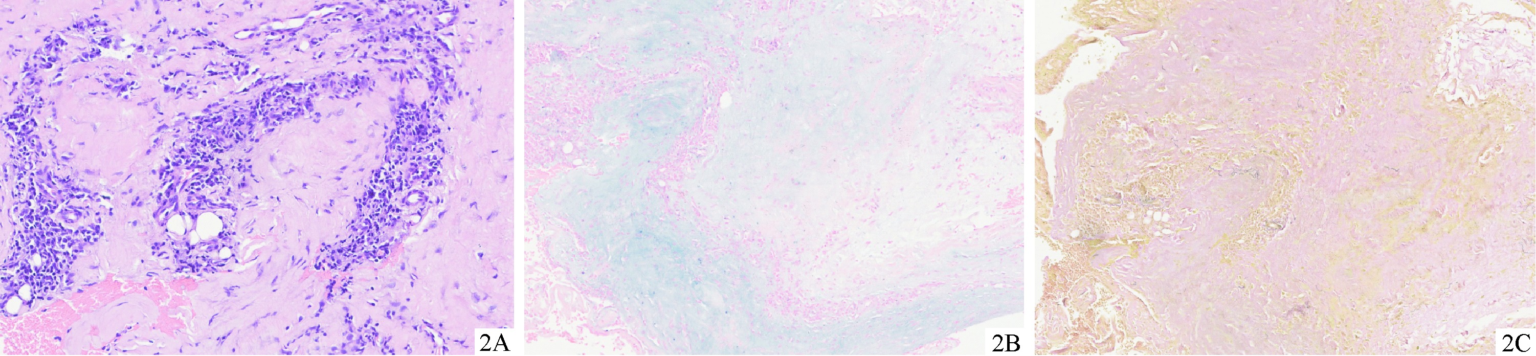 A case of eosinophilic fasciitis